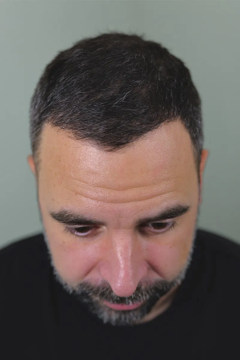 Après D.