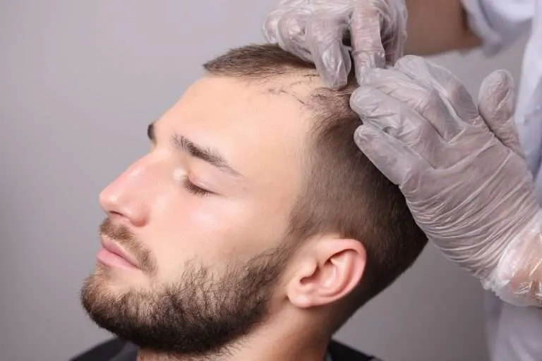 Homme avec des cheveux fins se regardant dans le miroir, s'interrogeant sur les possibilités d'une greffe.