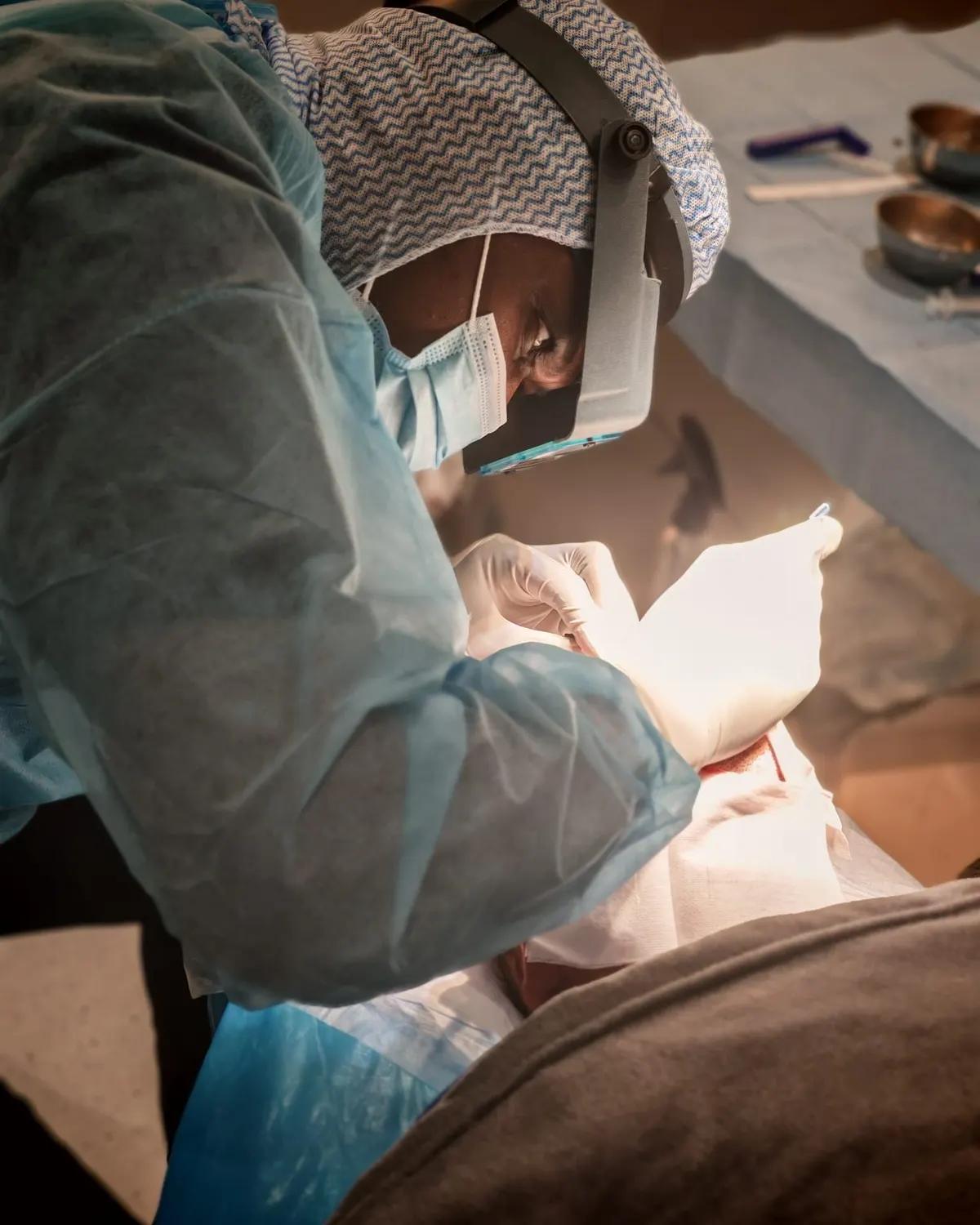 Qu’est-ce que la greffe de cheveux BHT (Body Hair Transplant) ?
